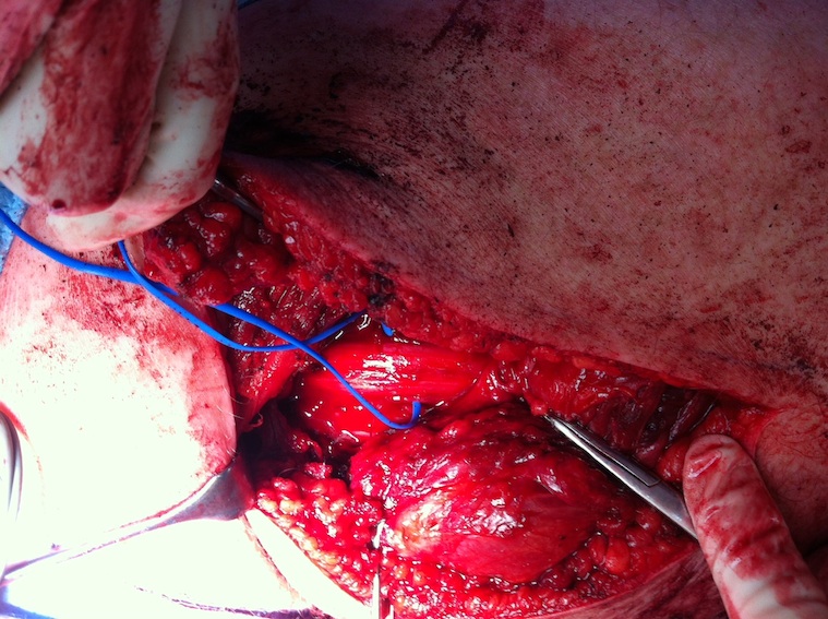 Hamstring Repair Sciatic Nerve 2